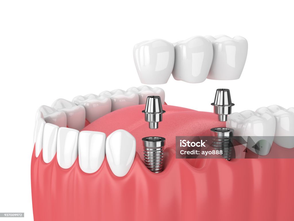 dental bridge