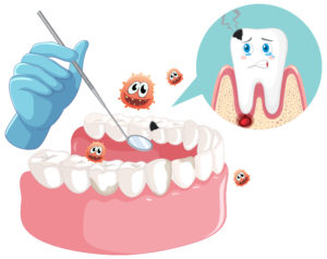 periodontal surgery